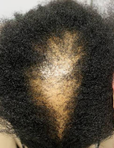 The Unbearable Impact of Alopecia in Black Women